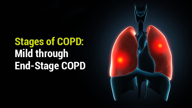 Stages of COPD: Mild through End-Stage COPD